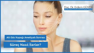 Alt Göz Kapağı Ameliyatı Sonrası Süreç Nasıl İlerler?|Alt Göz Kapağı Ameliyatı |Doç.Dr. Erdem Güven.