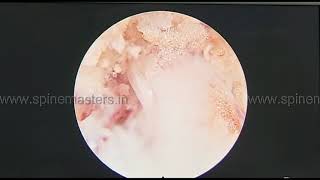 Endoscopic Transforaminal Disc Surgery (Maxmore Technique)