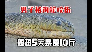 26岁男子被钩鼻海蛇咬伤！短短5天暴瘦10斤？