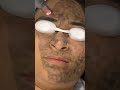 Carbon Laser Treatment Will Make You Tons Of Cash. Here's How #Carbon_laser_treatment #skinaaclinic