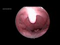 atrophic tonsils with granular pharyngitis.