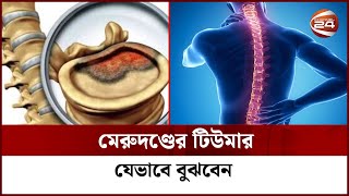 মেরুদণ্ডের টিউমার, যেভাবে বুঝবেন | Spinal cord tumor | Channel 24