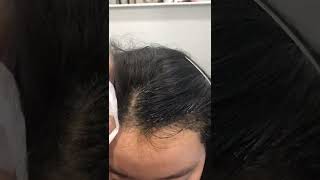 Hair Line Microblading processing 发际线纹绣过程