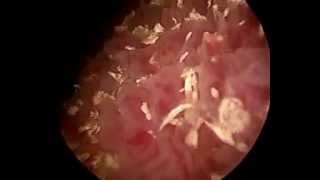 large bladder tumour - The Prostate Clinic