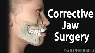 Corrective Jaw (Orthognathic) Surgery, Animation.