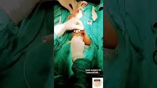Laser surgery for hemorrhoids #medicalstudent  #lasersurgery #hemorroidas #shrots #reels #mbbs