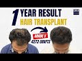 🔥Amazing Hair Transplant Results After 1 Year🔥 | 4273 Grafts Implant by Sapphire FUE Technique