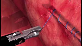 Laparoscopic Gastropexy For Large Breed Dogs | Veterinary Surgical Sutures With V-Loc Endostitch