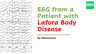 EEG in Lafora Body Disease