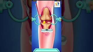 Knee Replacement Surgery 3D animation 🦵 #shorts #ytshorts #kneesurgery