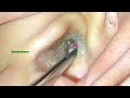 removing earwax reveals a shocking surprise inside ear wax removal pro