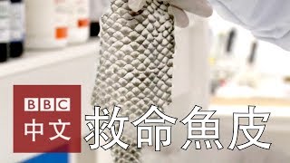 魚皮敷料——燒燙傷患者新曙光？