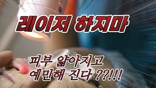 피부과 레이저치료 하지마 피부두께 얇아지고 예민 해진다고 하는데? 젊을때 레이저치료는 더욱 안된다.