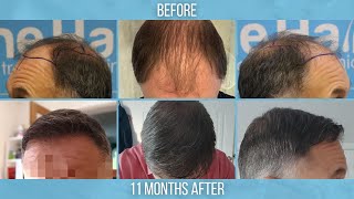 Norwood 5 FUE Hair Transplant by Dr Arshad