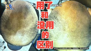 【1818黄金眼】花6000元改善脱发五个月，和以前一模一样？