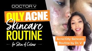 Doctor V - Oily, Acne Skincare Routine For Skin of Colour | Brown Or Black Skin
