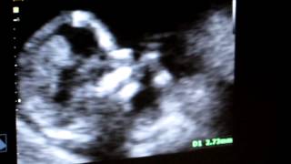 Nuchal translucency (NT) scan - 3 months of pregnancy - سونوگرافی سه ماهه اول حاملگی