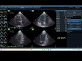 iq 218 autoef chocardiography echopac analysis measurement 2