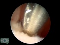 Hysteroscopy. Technique of biopsy