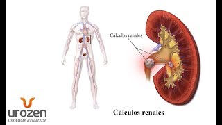 ¿Cómo se forman los cálculos renales?