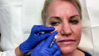 Mid-Face Filler with Dr. Sarhaddi