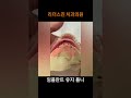 리더스진 치과의원 임플란트 연결 틀니 asmr 실제 틀니 영상有