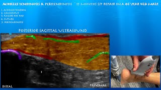 Ultrasound of a post-op Achilles by probeultrasound