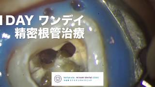 精密根管治療 　【愛知県刈谷市の歯医者】　ワンデイ　One Visit Root Canal Therapy　オンライン診療　自由診療　顕微鏡歯科　マイクロスコープ　Kariya city