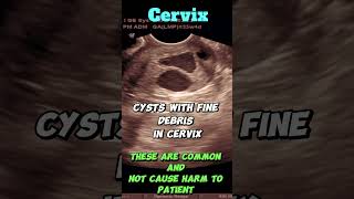 Nabothian Cysts in Cervix | TVS Ultrasound | is this serious?