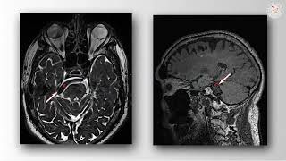 Dolichoectatic Basilar Artery and Trigeminal Neuralgia (Preview)