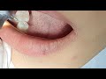 how to make dental filling