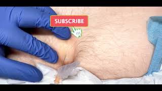 Drainage of an infected pilonidal cyst