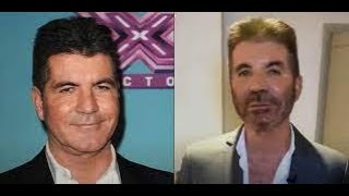 Plastic surgery rumors swirl around Simon Cowell