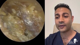 1,506 - Rare Ear Canal Cholesteatoma Follow-Up Procedure with Dead Skin Removal