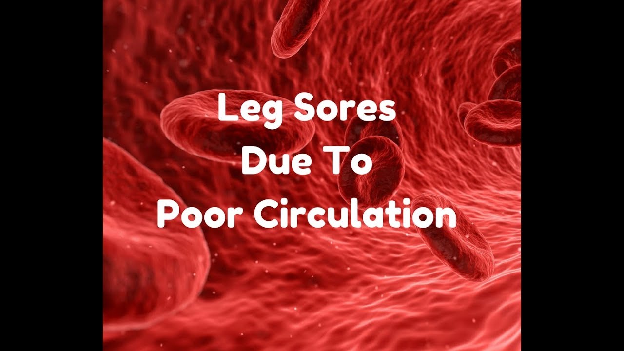 Leg Ulcers From Poor Circulation
