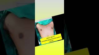 10 Sec Immediate Gynecomastia Surgery Results