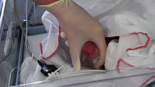 Capillary sampling on neonates for blood gas analysis