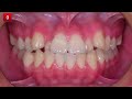 Treatment of Skeletal Class I Bimaxillary Protrusion｜【Chris Chang Ortho】CC791