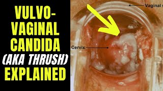 Doctor explains VULVOVAGINAL CANDIDIASIS (aka thrush) - including causes, symptoms \u0026 how to treat...