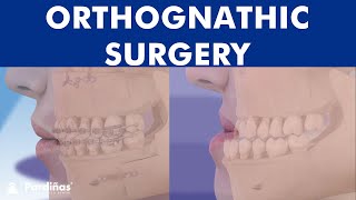 ORTHOGNATHIC surgery - All about JAW realignment surgery ©