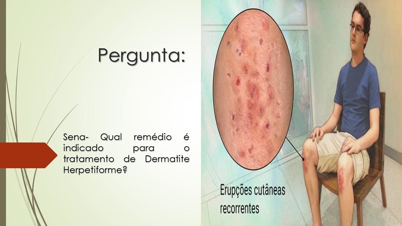 Dermatite Herpetiforme | Qual Remédio E Indicado Para O Tratamento De ...