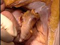 surgiwrap用於 結腸造口術（造口）colostomy stoma