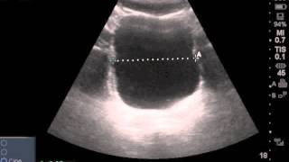 Ultrasound Post Void Residual