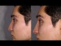 el dr. frank rosengaus nos explica sus técnicas de mejoramiento facial con métodos no invasivos