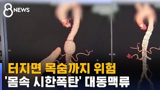 터지면 목숨까지 위험…'몸속 시한폭탄' 대동맥류 / SBS