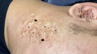 Big Cystic Acne Blackheads Extraction Blackheads \u0026 Milia, Whiteheads Removal Pimple Popping #0908