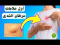 ماهي أول علامات سرطان الثدي ظهوراً ؟