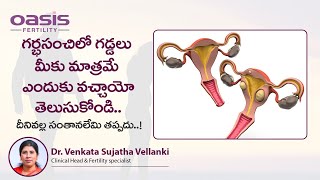 మీకు మాత్రమే గర్భసంచిలో గడ్డలు..? || Fibroids in Uterus and Treatment || Oasis Fertility