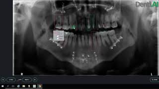 Denti.AI Auto-Chart Dentrix Integration
