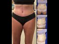 Dr. Farber Performs A Lipoabdominoplasty